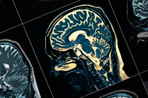Study Links Autism to Greater Risk of Early-Onset Parkinson’s